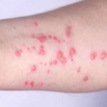 Boston residents encouraged to get mpox vaccine amid uptick in cases