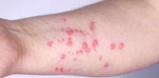 Boston residents encouraged to get mpox vaccine amid uptick in cases