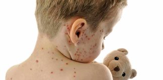 Measles Outbreak Surges Past 1,000 Cases Child with red spots on back holding a teddy bear